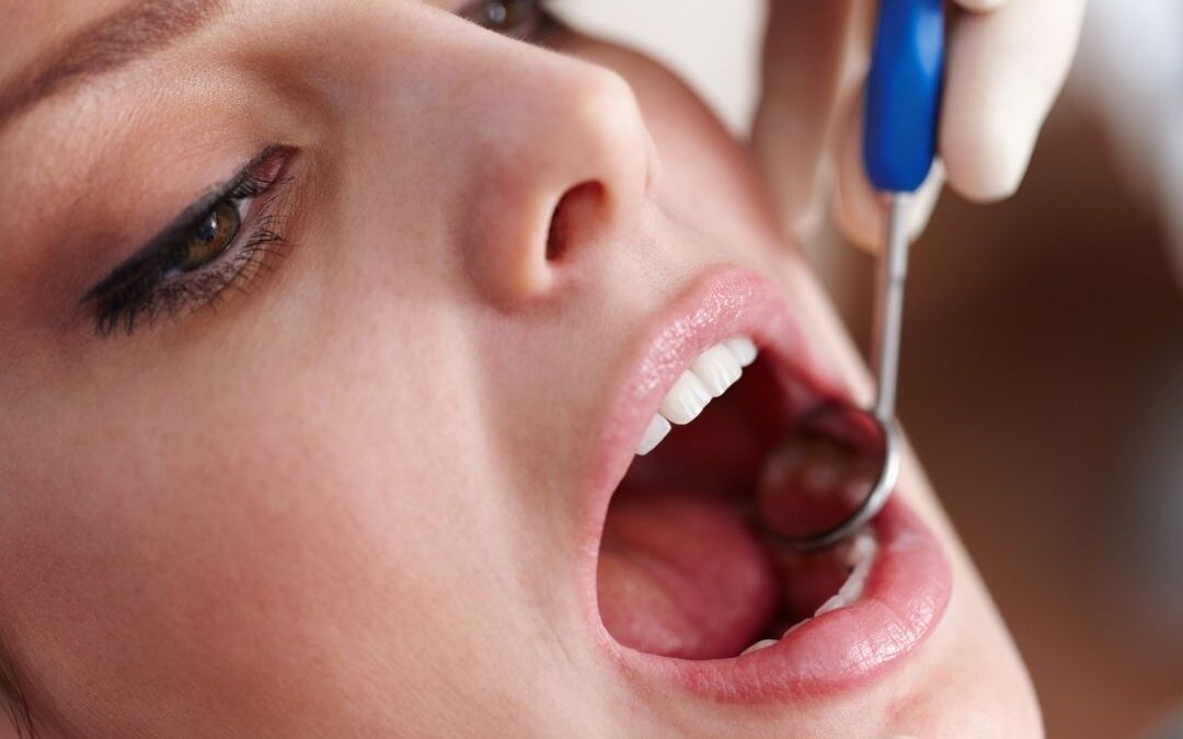 Candidiasis oral. Síntomas y tratamientos