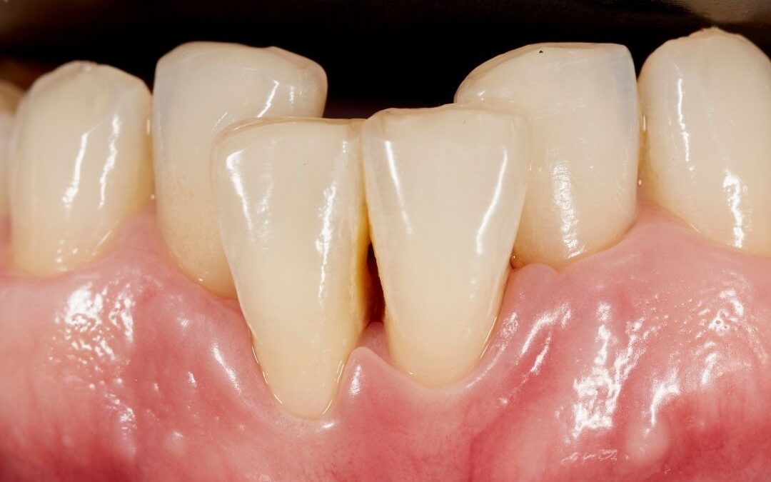 Apiñamiento dental. Causas, consecuencias y cómo corregirlo