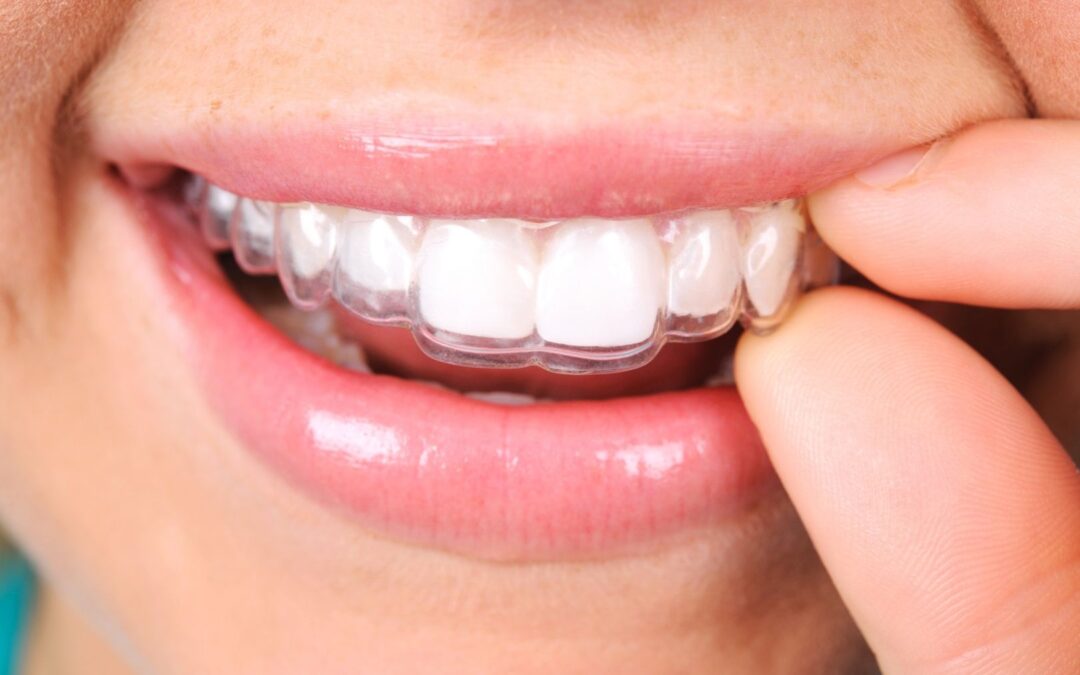 Retención en ortodoncia