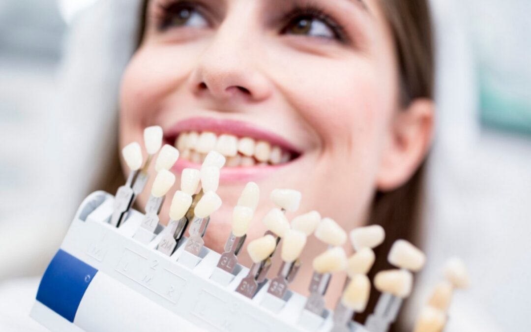 Carillas dentales. Tipos, ventajas y mantenimiento.