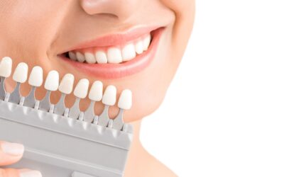 Coronas dentales. Tipos y características