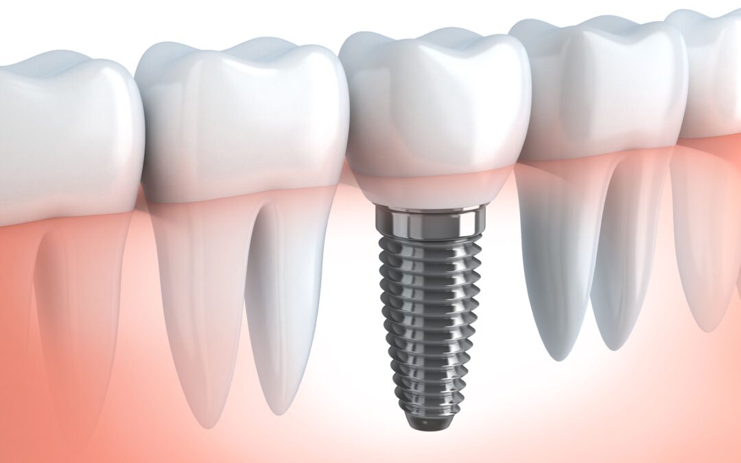 Cuidados después de los implantes dentales.