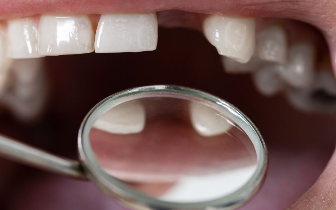 ¿Qué consecuencias tiene la falta de dientes?
