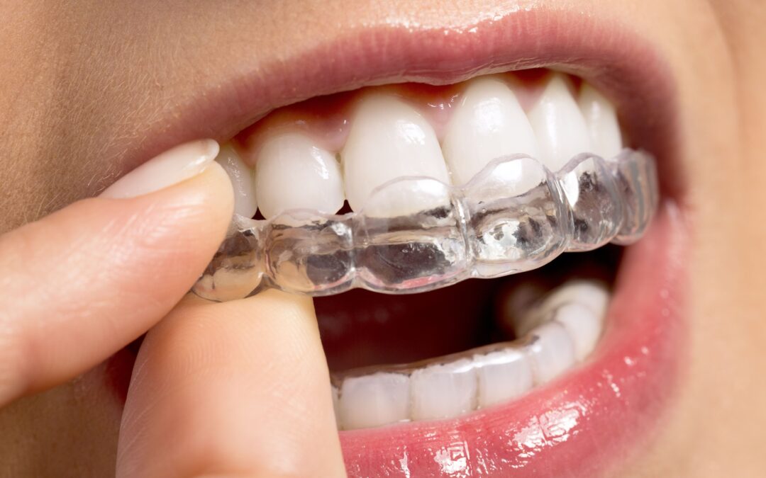 Consejos para garantizar el éxito de tu tratamiento de ortodoncia en Vinaròs.