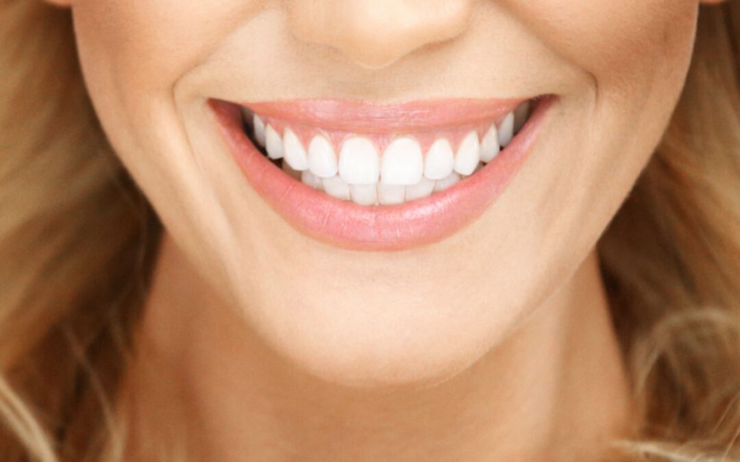 La solución para los dientes amarillos, ¿blanqueamiento o carillas?