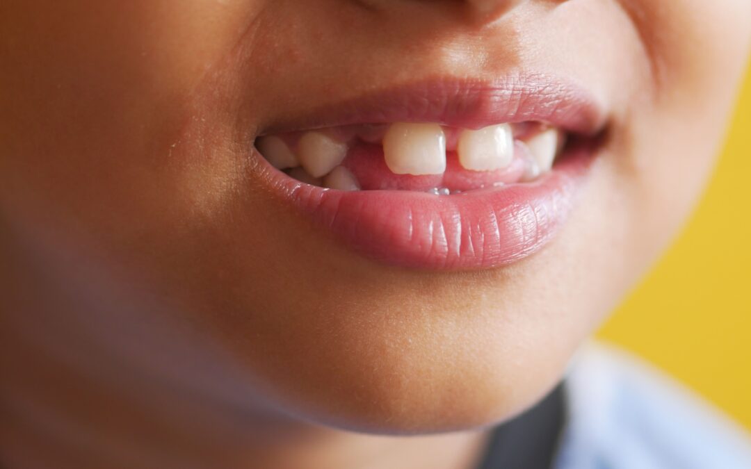 Manchas blancas en los dientes de mi hijo. Causas y tratamientos