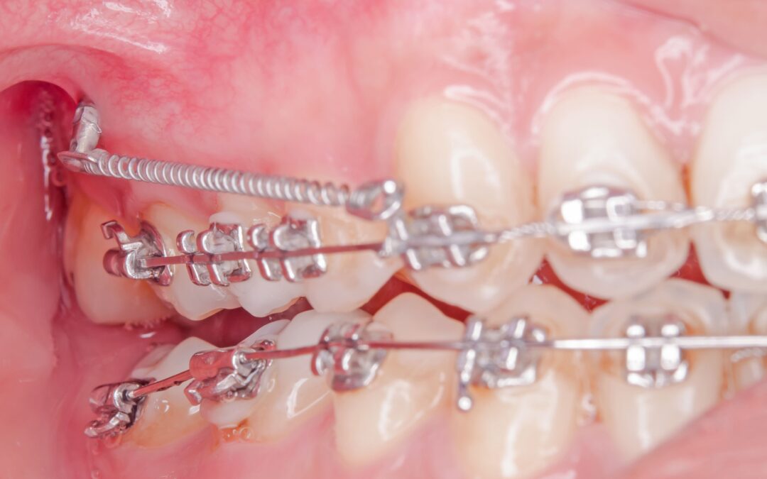 Microimplantes en ortodoncia ¿cuándo se ponen y para qué sirven?