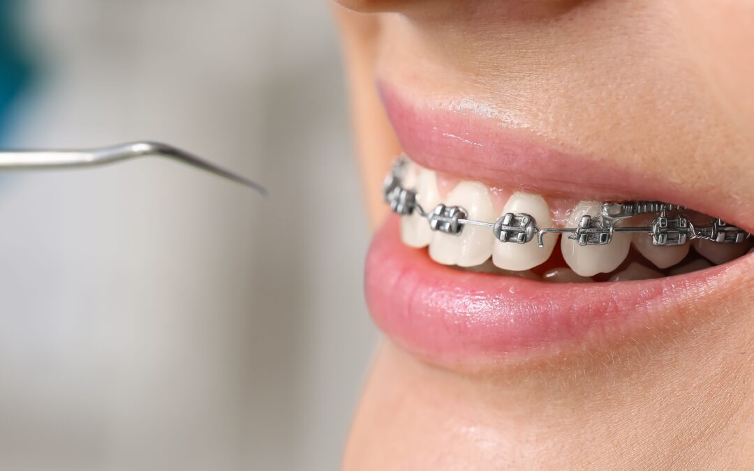 Implantes dentales y ortodoncia ¿Cuál va primero?