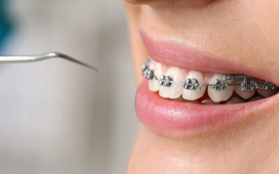Implantes dentales y ortodoncia ¿Cuál va primero?