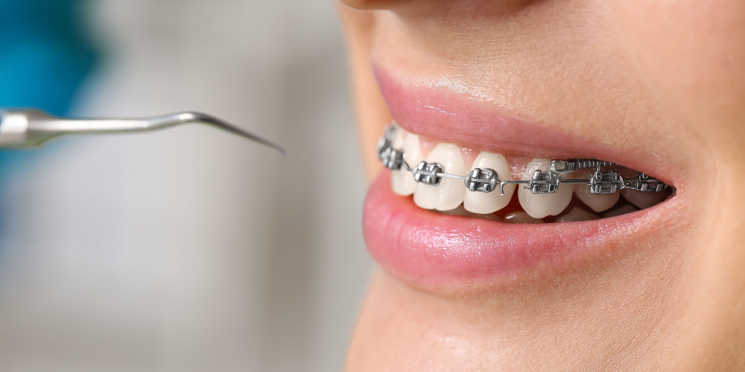 ¿Cuándo es el momento adecuado para los implantes dentales, antes o después de la ortodoncia? ¡Vamos a profundizar en el tema!