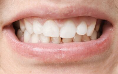 El impacto de una mala mordida en la salud dental