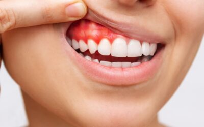 Periodontitis crónica; herramientas de prevención