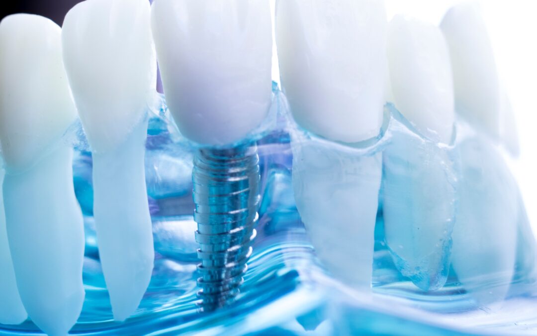 Implantología dental en Vinaròs: desmontando mitos