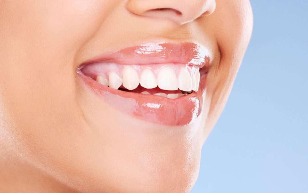 Blanqueamiento dental: mitos, verdades y consejos para un resultado duradero