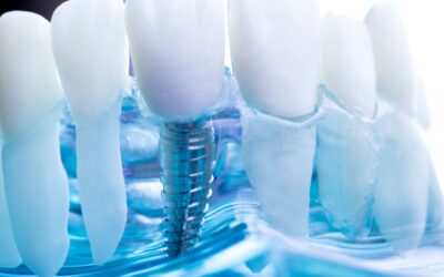 ¿Cómo la implantología puede ayudar en casos de pérdida dental prematura?