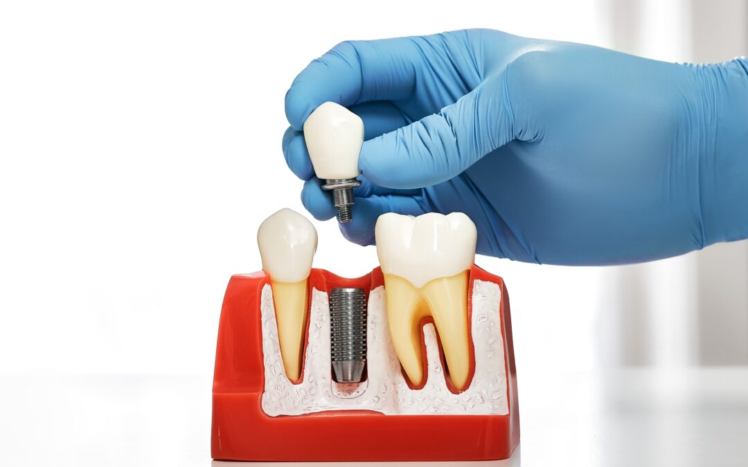 ¿Cómo la implantología puede ayudar en casos de pérdida dental prematura?