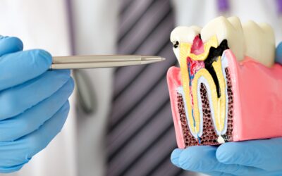 Prevención de caries: guía completa para una boca sana