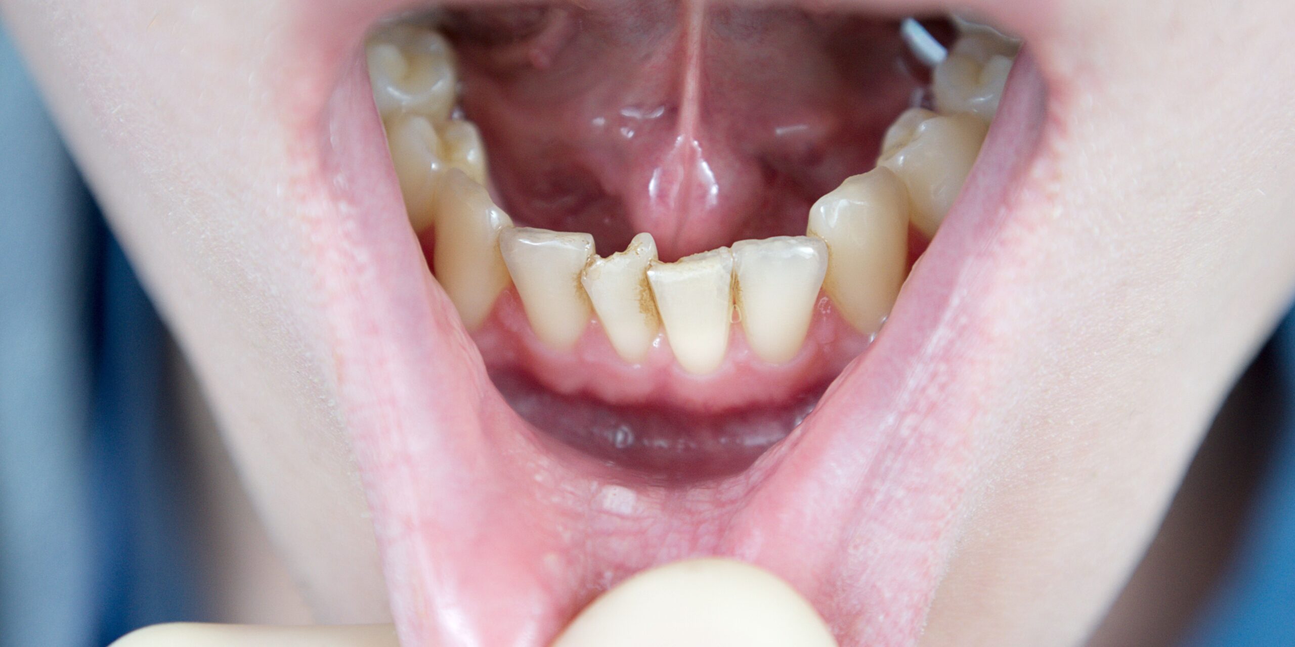 dientes apiñados