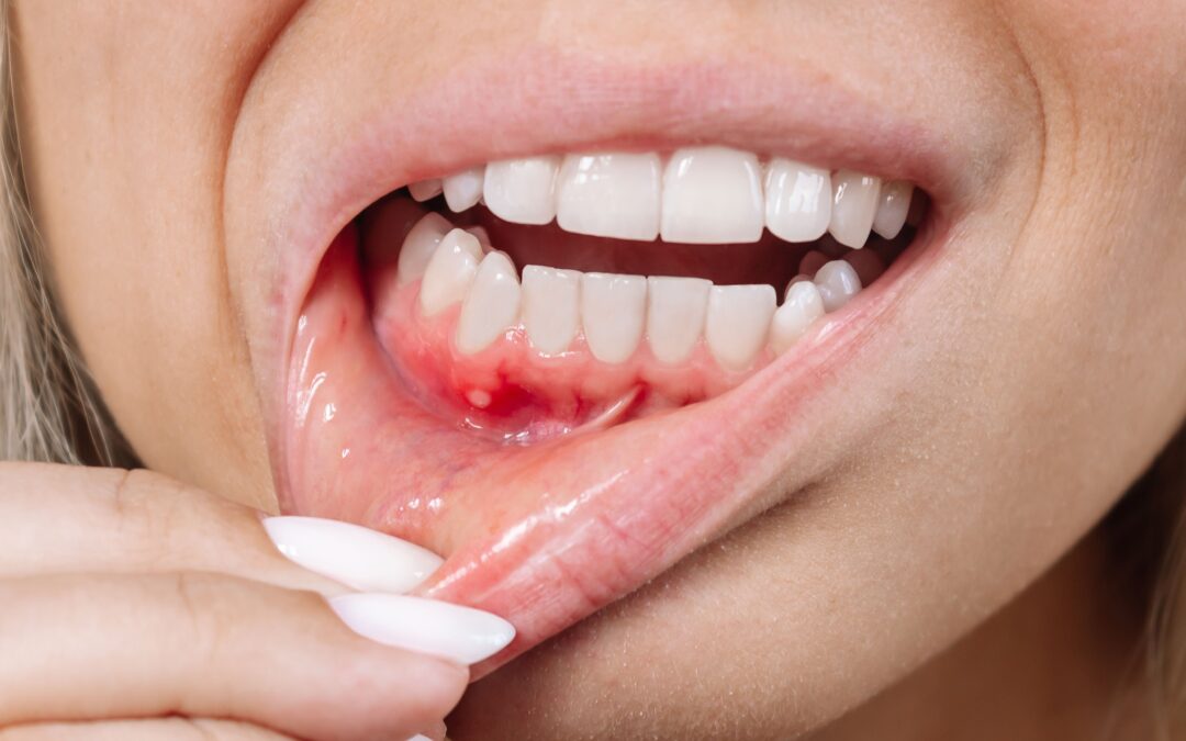 Bolsas periodontales: por qué aparecen y cómo solucionarlas