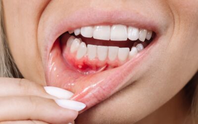 Bolsas periodontales: por qué aparecen y cómo solucionarlas