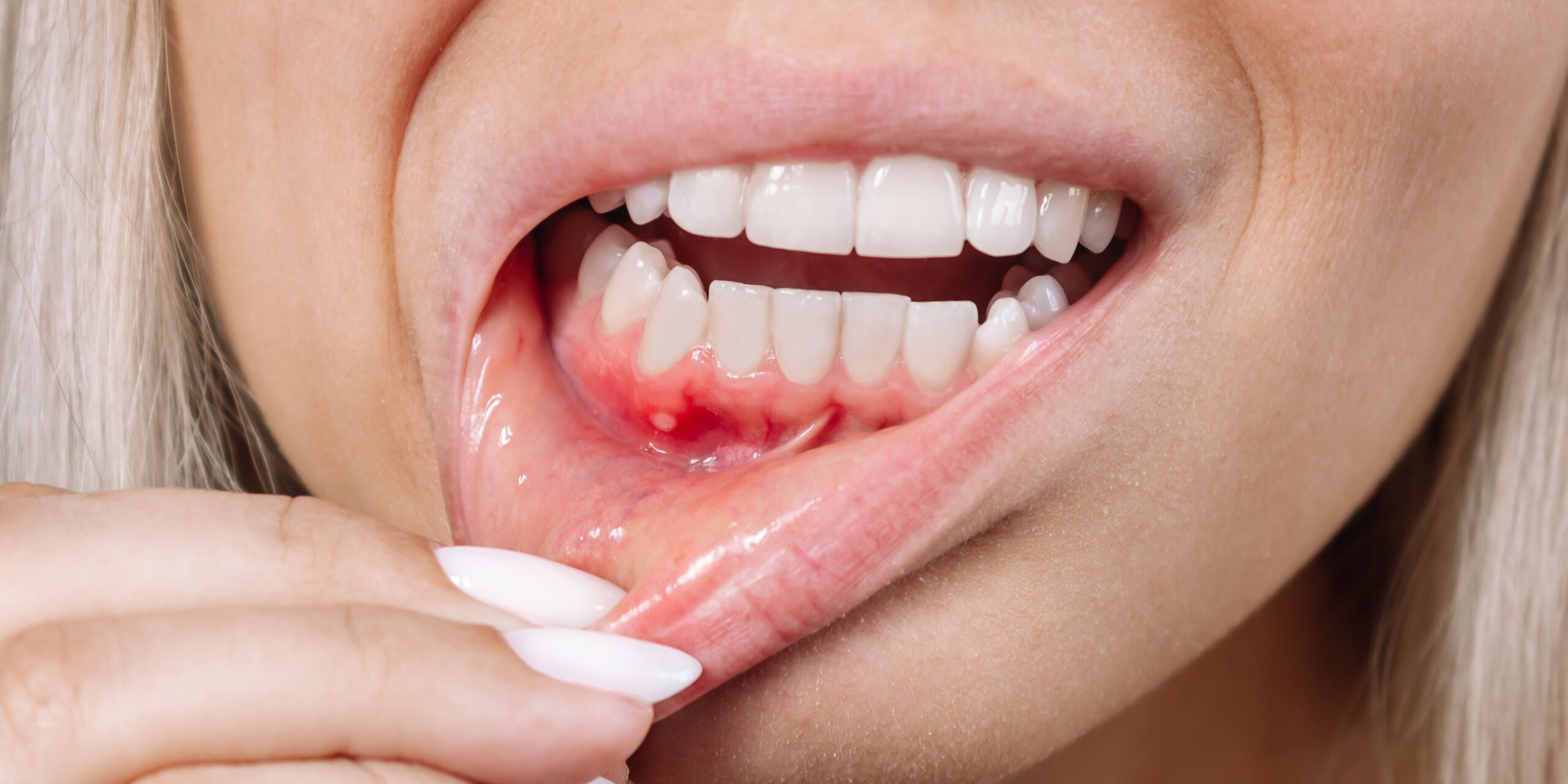 Bolsas periodontales Bolsas periodontales