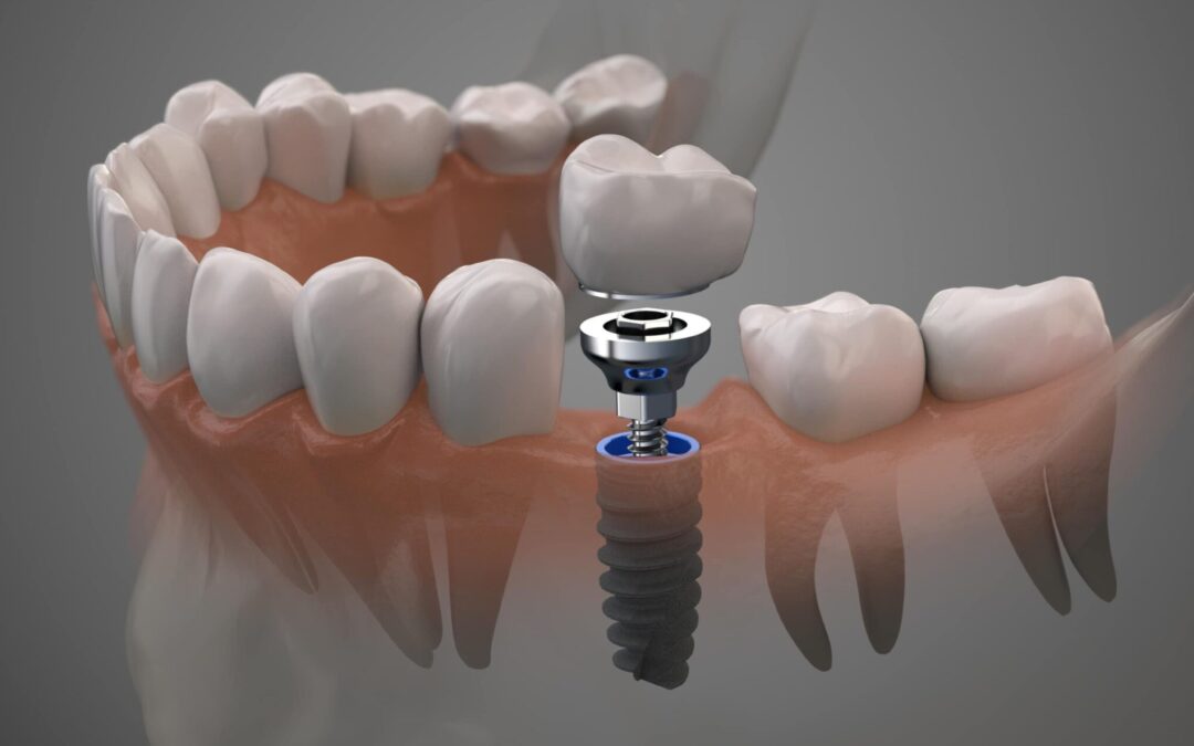 Cirugía avanzada y regeneración ósea: el presente de los implantes dentales de precisión en Vinaròs