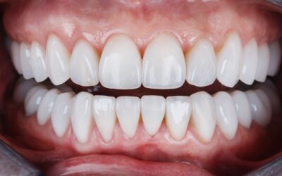 Carillas dentales en Vinaròs: las 7 preguntas que más nos hacen los pacientes