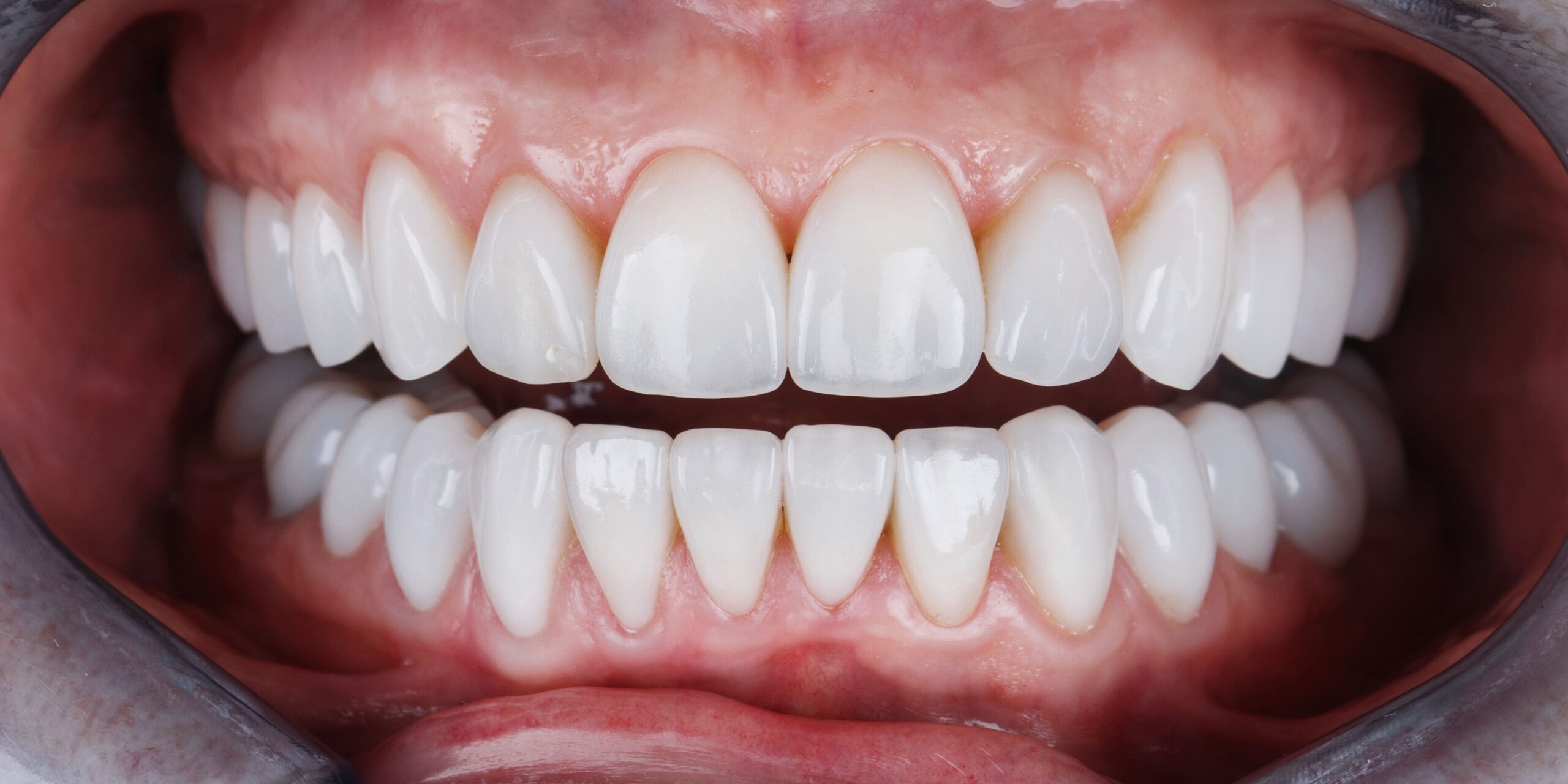 Carillas dentales en Vinaròs
